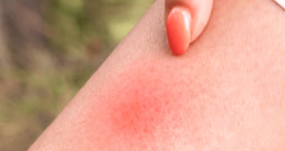 Infected Insect Bites