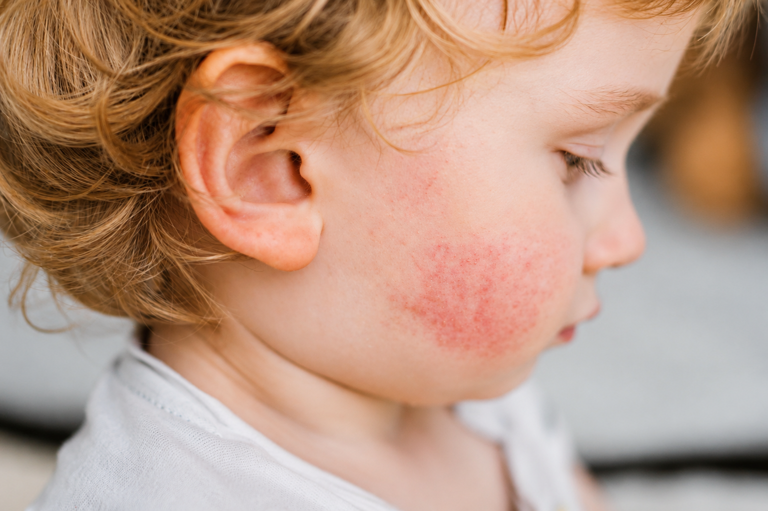 Impetigo