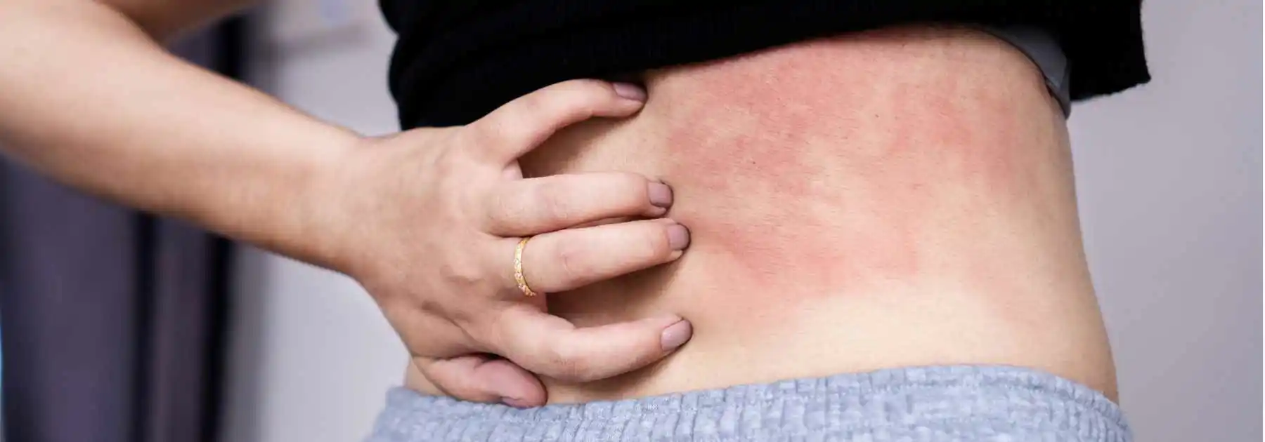 Shingles
